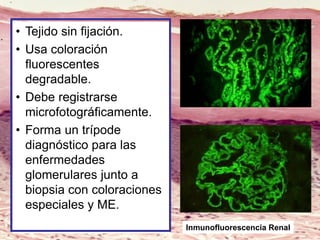 • Tejido sin fijación.
• Usa coloración
fluorescentes
degradable.
• Debe registrarse
microfotográficamente.
• Forma un trípode
diagnóstico para las
enfermedades
glomerulares junto a
biopsia con coloraciones
especiales y ME.
Inmunofluorescencia Renal
 