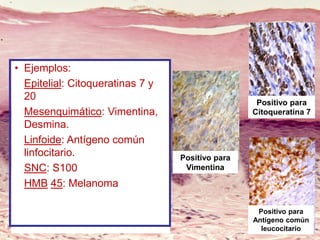 • Ejemplos:
Epitelial: Citoqueratinas 7 y
20
Mesenquimático: Vimentina,
Desmina.
Linfoide: Antígeno común
linfocitario.
SNC: S100
HMB 45: Melanoma
Positivo para
Citoqueratina 7
Positivo para
Vimentina
Positivo para
Antígeno común
leucocitario
 