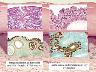 Imagen de lesión endometrial
con HE y Proteína PTEN reactiva Lesión serosa endometrial con HE y
p53 reactiva
 