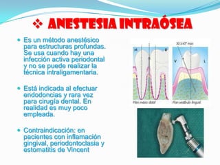  Anestesia Intraósea
 Es un método anestésico
para estructuras profundas.
Se usa cuando hay una
infección activa periodontal
y no se puede realizar la
técnica intraligamentaria.
 Está indicada al efectuar
endodoncias y rara vez
para cirugía dental. En
realidad es muy poco
empleada.
 Contraindicación: en
pacientes con inflamación
gingival, periodontoclasia y
estomatitis de Vincent
 