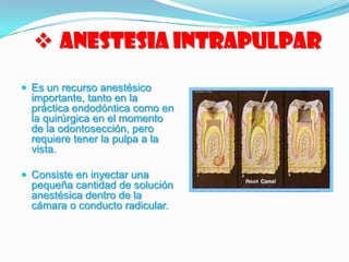  Anestesia Intrapulpar
 Es un recurso anestésico
importante, tanto en la
práctica endodóntica como en
la quirúrgica en el momento
de la odontosección, pero
requiere tener la pulpa a la
vista.
 Consiste en inyectar una
pequeña cantidad de solución
anestésica dentro de la
cámara o conducto radicular.
 