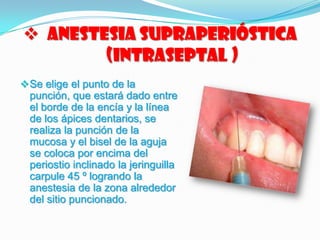  Anestesia Supraperióstica
(Intraseptal )
Se elige el punto de la
punción, que estará dado entre
el borde de la encía y la línea
de los ápices dentarios, se
realiza la punción de la
mucosa y el bisel de la aguja
se coloca por encima del
periostio inclinado la jeringuilla
carpule 45 º logrando la
anestesia de la zona alrededor
del sitio puncionado.
 