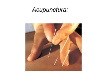 Acupunctura:
 