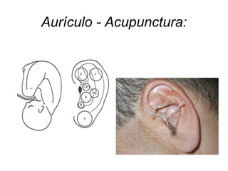 Aurículo - Acupunctura:
 