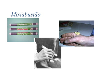 Moxabustão
 