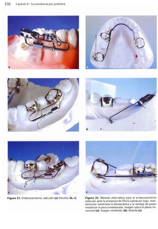 Tecnicas Ortodonticas