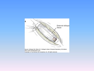 Tecnicas plastia inguinal