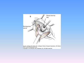 Tecnicas plastia inguinal