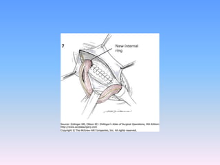 Tecnicas plastia inguinal