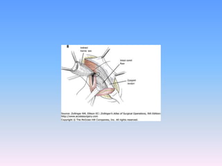 Tecnicas plastia inguinal
