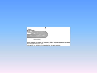 Tecnicas plastia inguinal