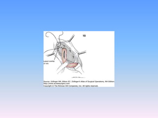 Tecnicas plastia inguinal