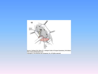 Tecnicas plastia inguinal