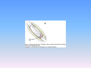 Tecnicas plastia inguinal