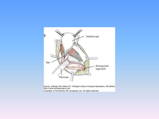 Tecnicas plastia inguinal