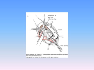 Tecnicas plastia inguinal