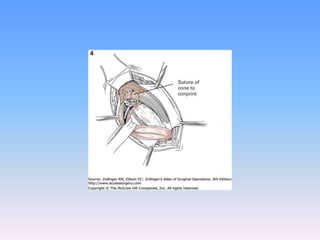 Tecnicas plastia inguinal