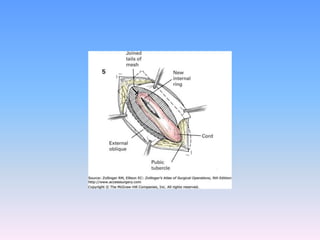 Tecnicas plastia inguinal