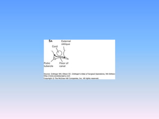 Tecnicas plastia inguinal