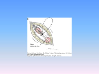 Tecnicas plastia inguinal