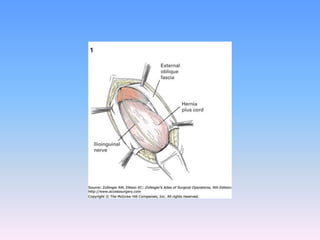 Tecnicas plastia inguinal