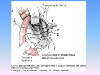 Tecnicas plastia inguinal