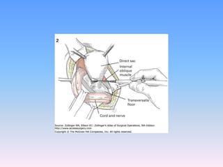 Tecnicas plastia inguinal