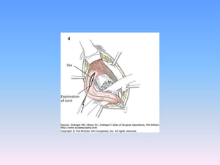 Tecnicas plastia inguinal