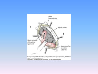 Tecnicas plastia inguinal