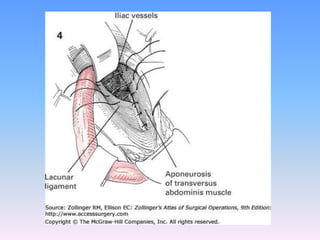 Tecnicas plastia inguinal