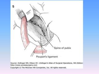 Tecnicas plastia inguinal