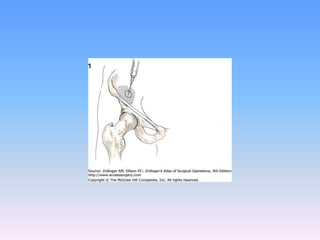 Tecnicas plastia inguinal