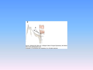 Tecnicas plastia inguinal