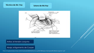 Mcvay Incision Técnicas Quirúrgicas para la Reparación de Hernias Inguinales ...