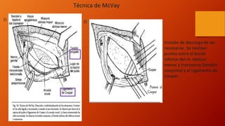 Mcvay Incision Tecnicas quirurgicas inguinal. Hernia crural..pptx