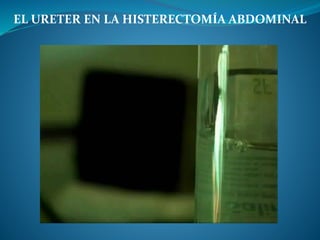 EL URETER EN LA HISTERECTOMÍA ABDOMINAL