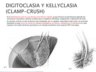 En el parénquima sano es una técnica muy eficaz y rápida, ya que fractura el parénquima dejando las
estructuras vasculares y biliares visibles para su ligadura individual, coagulación o aplicación de clips.
En muchos centros es aún la técnica más empleada, por su rapidez, seguridad y bajo coste. Su principal
limitación es que no es tan eficaz en hígados patológicos (cirróticos, esteatósicos o colestásicos) y que
requiere una mayor destreza quirúrgica y un manejo anestésico muy experto (PVC muy baja).
 