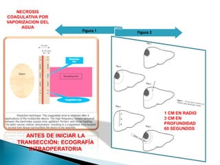 Figura 1 Figura 2
ANTES DE INICIAR LA
TRANSECCIÓN: ECOGRAFÍA
INTRAOPERATORIA
NECROSIS
COAGULATIVA POR
VAPORIZACION DEL
AGUA
1 CM EN RADIO
3 CM EN
PROFUNDIDAD
60 SEGUNDOS
 