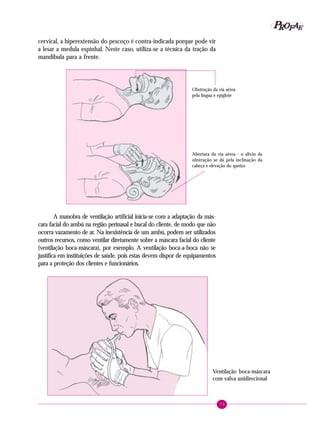 73
PPPPP EEEEEAAAAARRRRROOOOOFFFFF
cervical, a hiperextensão do pescoço é contra-indicada porque pode vir
a lesar a medula espinhal. Neste caso, utiliza-se a técnica da tração da
mandíbula para a frente.
A manobra de ventilação artificial inicia-se com a adaptação da más-
cara facial do ambú na região perinasal e bucal do cliente, de modo que não
ocorra vazamento de ar. Na inexistência de um ambú, podem ser utilizados
outros recursos, como ventilar diretamente sobre a máscara facial do cliente
(ventilação boca-máscara), por exemplo. A ventilação boca-a-boca não se
justifica em instituições de saúde, pois estas devem dispor de equipamentos
para a proteção dos clientes e funcionários.
Abertura da via aérea - o alívio da
obstrução se dá pela inclinação da
cabeça e elevação do queixo
Ventilação boca-máscara
com valva unidirecional
Obstrução da via aérea
pela língua e epiglote
 