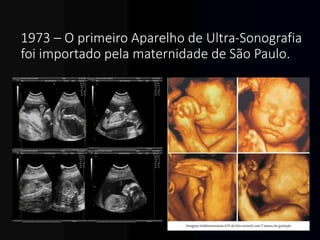 1973 – O primeiro Aparelho de Ultra-Sonografia
foi importado pela maternidade de São Paulo.
 
