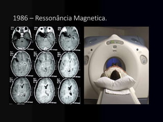 1986 – Ressonância Magnetica.
 