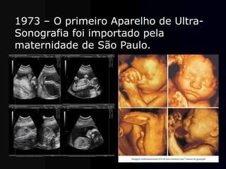 1973 – O primeiro Aparelho de Ultra-
Sonografia foi importado pela
maternidade de São Paulo.
 