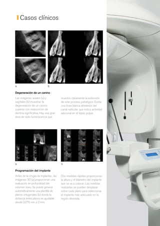 Casos clínicos




a                            b

Degeneración de un canino
Las imágenes axiales (a) y               muestra claramente la extensión
sagitales (b) muestran la                de este proceso patológico. Existe
degeneración de un canino                una línea blanca alrededor del
superior con reabsorción de              canal radicular que indica actividad
dentina significativa. Hay una gran      adicional en el tejido pulpar.
área de radio luminiscencia que




a                                        b

Programación del implante
Antes de la cirugía de implantes , las   Dos medidas rápidas proporcionan
imágenes 3D (a) proporcionan una         la altura y el diámetro del implante
evaluación en profundidad del            que se va a colocar. Las medidas
volumen óseo. Se puede generar           realizadas se pueden desplazar
automáticamente una plantilla de         sobre cada plano para seleccionar
planos ortogonales (b) donde la          el implante más adecuado en la
distancia entre planos es ajustable      región deseada.
desde 0,076 mm a 2 mm.
 