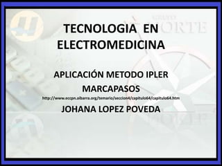 TECNOLOGIA EN
       ELECTROMEDICINA

     APLICACIÓN METODO IPLER
           MARCAPASOS
http://www.eccpn.aibarra.org/temario/seccion4/capitulo64/capitulo64.htm

         JOHANA LOPEZ POVEDA
 