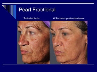 Fototermólisis SelectivaEstructuras pigmentadasEliminación Transepidermica ó eExteriorización:En lesiones epidérmicas, como en el léntigo y efélides, el cromóforo epidérmico, la melanina, absorbe las longitudes de onda de la LIP y Láser y transforma esa energía lumínica en energía calórica (de 60 a 90 grados). Esto produce epidermólisis hasta la capa basal y se eliminan los melanosomas. Se forma una costra o escara superficial por muerte celular, que se exfolia a los 3-7 días. 