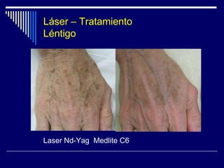 TIPOS DE LASERLaser CO2Cromóforo: Agua intracelular y extracelular.Longitud de onda: 10600 nm. (infrarrojo).Diferentes modos de emisión:Onda ContínuaOnda PulsadaOnda Franccionada