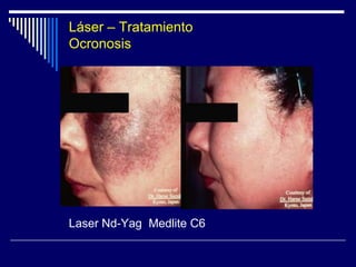 TIPOS DE LASERLaser CO2Onda continua: Focalizada: Para corte quirúrgicoDesfocalizada:  Efecto vaporizador en lesiones tumorales cutáneas benignas y malignas y tatuajes, con poca hemorragia. En un 1-4 % - Cicatrices hipertróficas.Onda Pulsada: Uso cosmético por su efecto ablativo para rejuvenecimiento cutáneo.Sus efectos secundarios implican un tiempo de re-epitelización de 6-8 semanas, con edema, eritema y trastornos de la pigmentación transitorios.