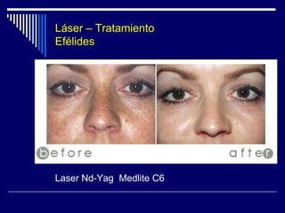 TIPOS DE LASERLaser Erbio - YAGSiglas de YAG: Itrio-Aluminio-Garnet. 	Cromóforo: agua intracelular y extracelular.Longitud de onda: 2940 nm. (infrarrojo).Las mismas indicaciones que el láser de CO2, pero:Profundiza 10 veces menos en la pielTratamiento menos agresivo, con un menor tiempo de recuperación.