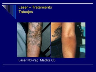 TIPOS DE LASERPearl Fraccionado YSGG de 2790 nm. Es nueva tecnología: Fraccionada.  La tecnologia se llama YSGG desarrollada por CUTERA, y el tratamiento se hizo con el PEARL FRACCIONADO YSGG de 2790 nm.Novedoso:  Resultado final obtenido con una sola sesión.