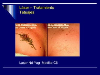 Pearl FractionalPretratamiento6 Semanas post-tratamiento